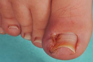 A-Z_ingrown-toenail-2_21012020