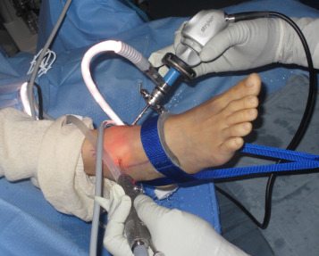 ankle scope 2 pic