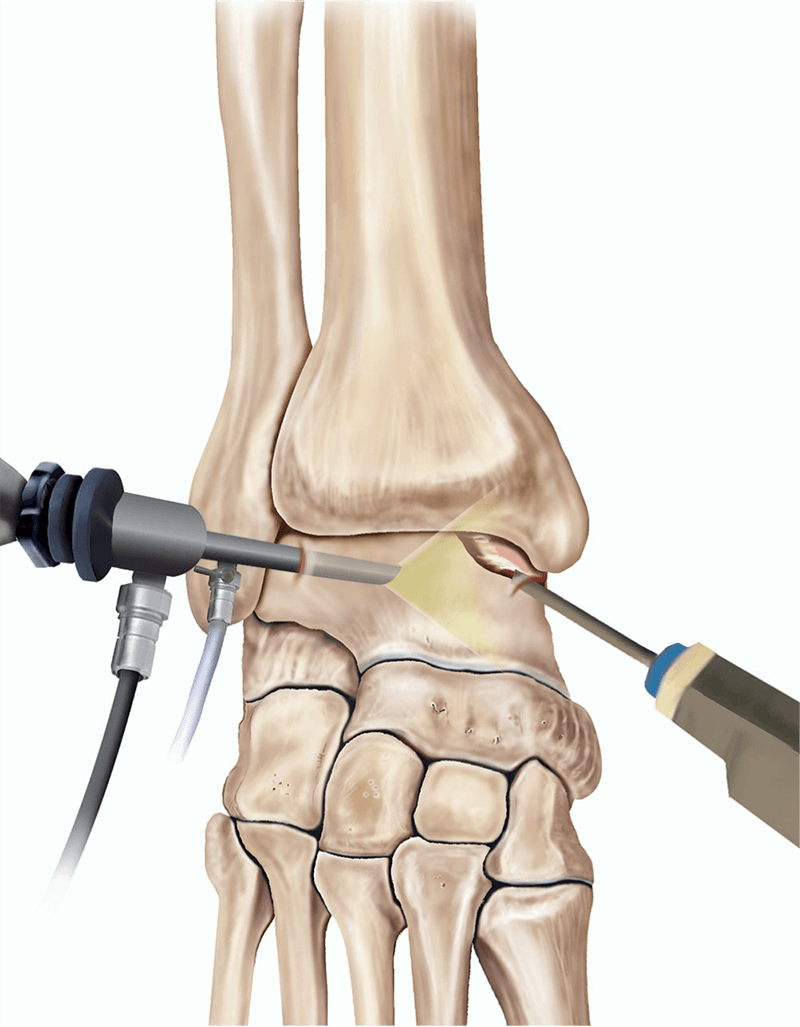 ankle scope photos