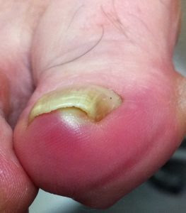 ingrown toenail