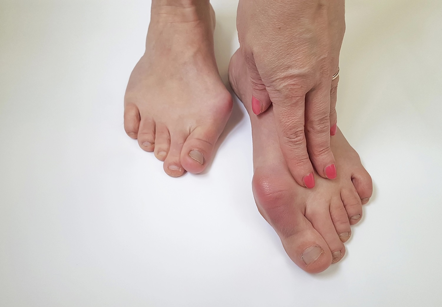 bunion pain photo