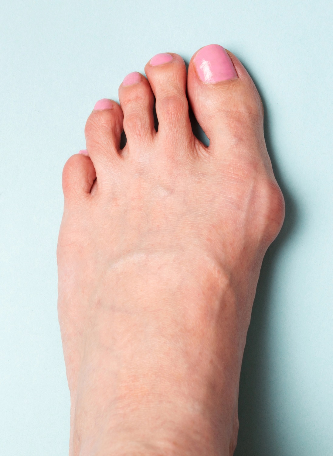 bunion vertical